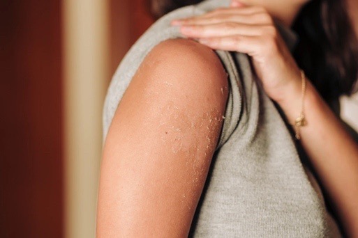 Burn or sunburn care